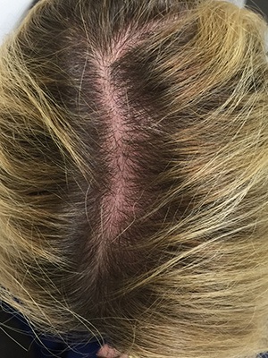 29yo female scalp -November 2015